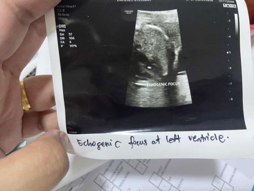 Hi, anyone boleh tak share yang pernah ada Echogenic Focus area kiri macam mana keadaan baby now ? 🙏🏼
