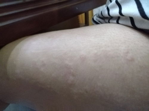 FTM
9 weeks pregant
Experiencing allergies