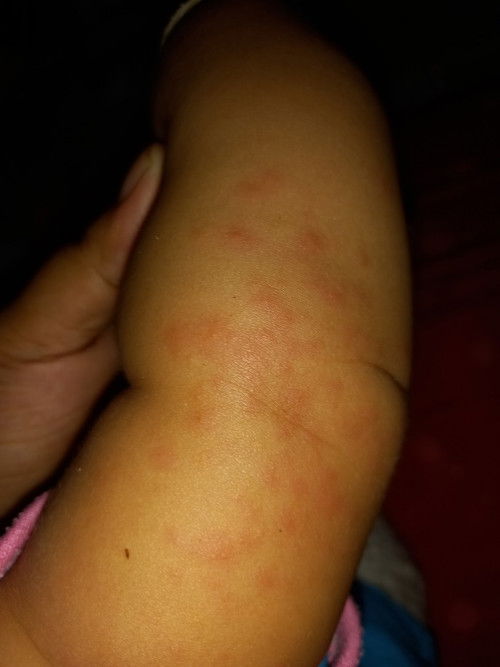 ลูกเป็นผื่น