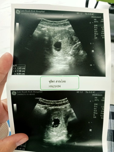 อัลตร้าซาวด์ท้องแรก