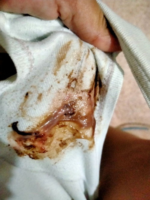 Brown discharge after ie in my third trimester.