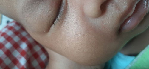 Bruntusan di bayi umur 1 blan 27 hari