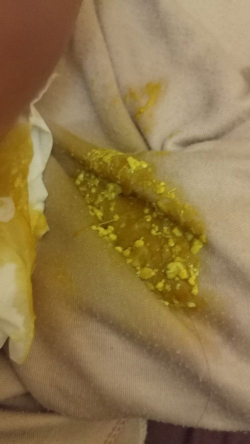 Ini normal ga ya pup anak ku ada serat warna putih gtu