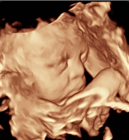 3D/4D ultrasound