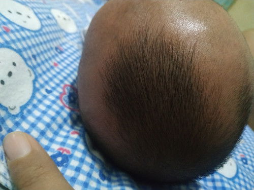 Rambut tumbuh tidak rata