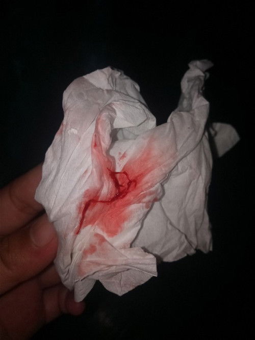 เรามีเลือดออก แบบนี้ค่ะ ไปหาหมอแล้วหมอบอกไม่เป็นอะไร ลูกเราดิ้นปกติไม่เจ็บท้อง เลือกออกแปปเดียวก็หาย