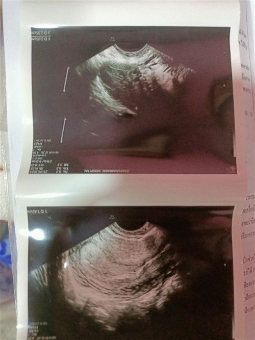 ยังไม่เจอถุงตั้งครรภ์