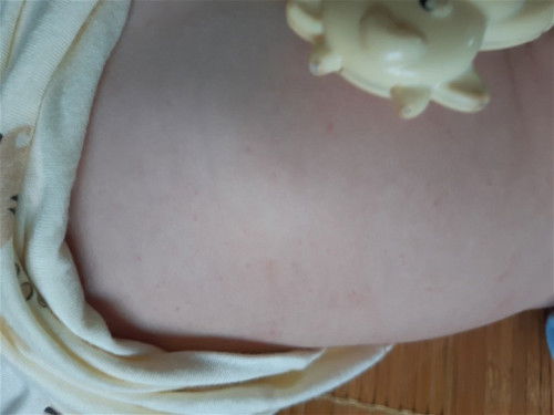 Bé nổi nốt đỏ