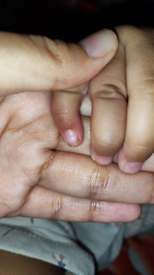 Kuku anak 1 tahun ada garis putih