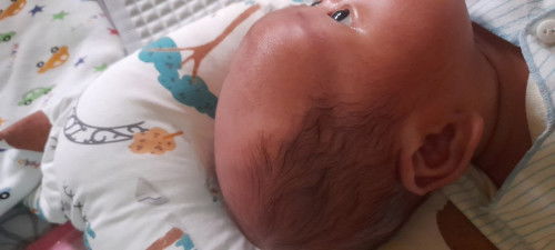 Rambut debay botak di bagian depan