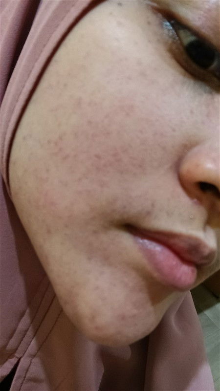 Bun ada yang pernah kayak gini gak? Ini gak papa gak ya? pagi tadi gaada, bangun tidur baru muncul