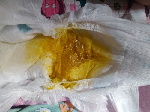 Efek samping pasca imunisasi