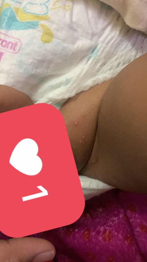 Bintik bintik pada kulit bayi 16 bulan