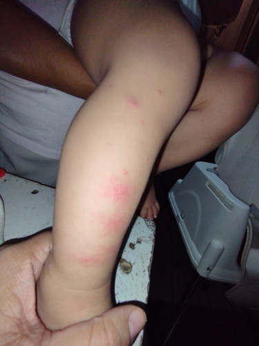 BLISTERS OR RASHES