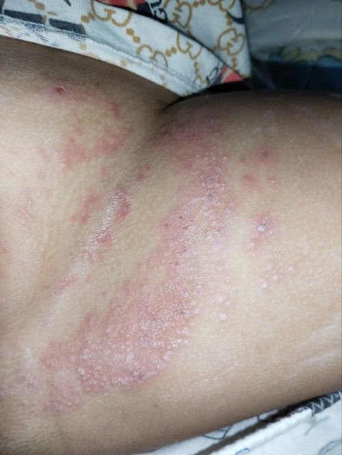 มีผื่นขึ้นเเดง