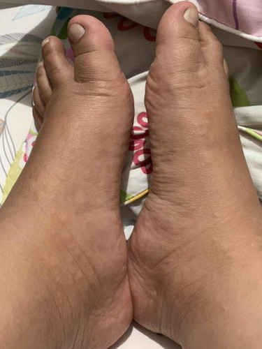 Bentol banyak di kaki
