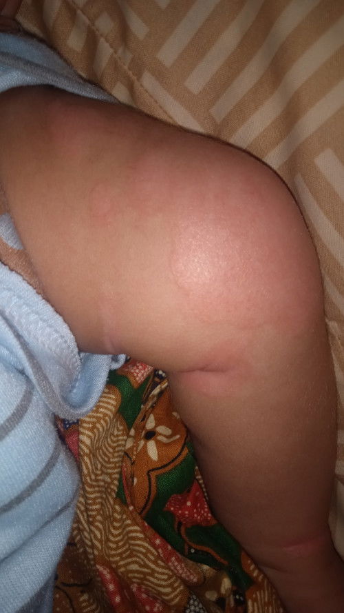 Kesehatan anak 
Bun ini kenapa ya, kulit anak saya gini
Abis mandi langsung merah l