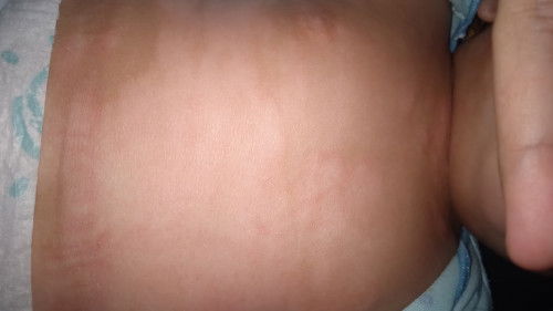 Kesehatan kulit anak
Bun ini kenapaa ya udah 3 minggu kulit anak saya gini