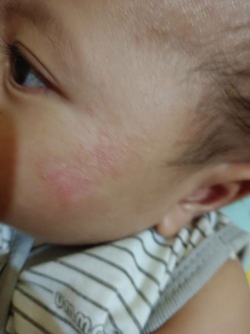 Wajah anak merah & kasar