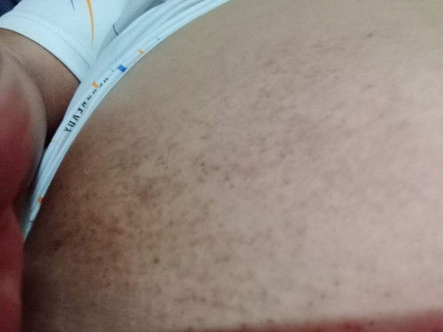 ผื่นแดงหายทิ้งรอยดำ