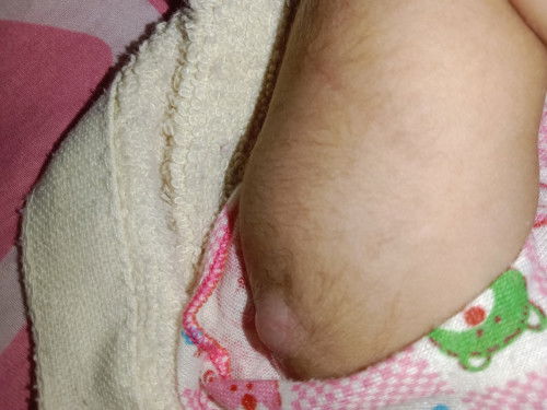 ฝีขนาดนี้ปกติมั้ยคะท้องแรกค่ะ