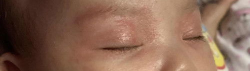 น้องมีผื่นแดงขึ้นบริเวณรอบตา