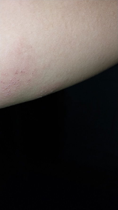 Gatal tapi tidak panas