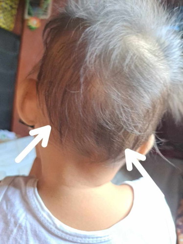 Ano po kaya itong 2 pea sized na bukol sa likod ng baby ko π