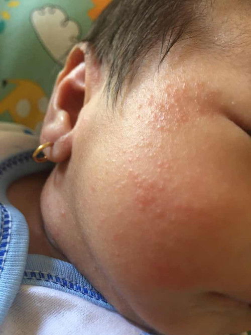 bintik2 merah di wajah baby