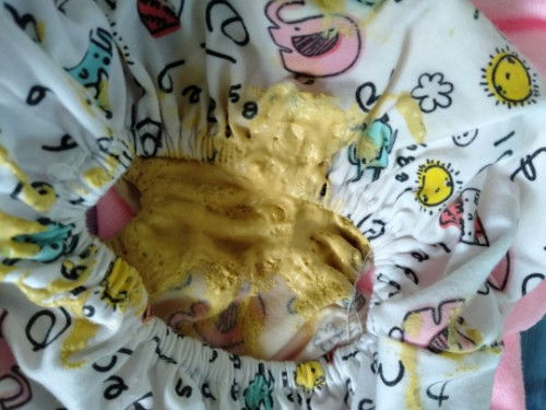 ลูก3เดือน5วันถ่ายแบบนี้ผิดปกติไหมคะ