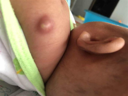 ปลูกฝีตอนน้องคลอดก่อนออกจาก รพ