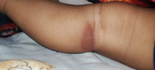 Kaki bayi luka/lecet dibagian belakang lutut.