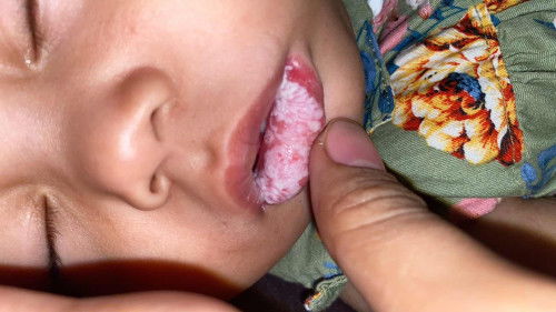 Jamur mulut bayi 8 bulan