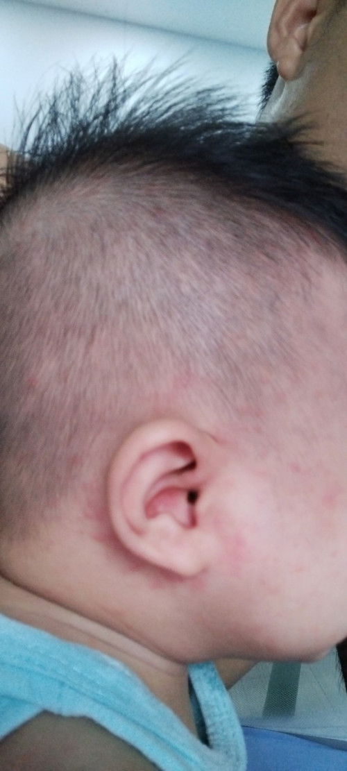 Phản ứng sau khi tiêm