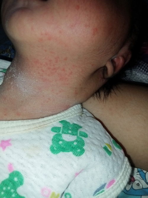 Ruam susu apa biang keringat