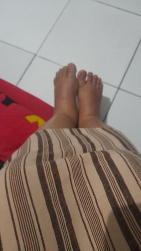 Bun ada gk si yg sudah lahiran tapi kakinya msih bengkak?