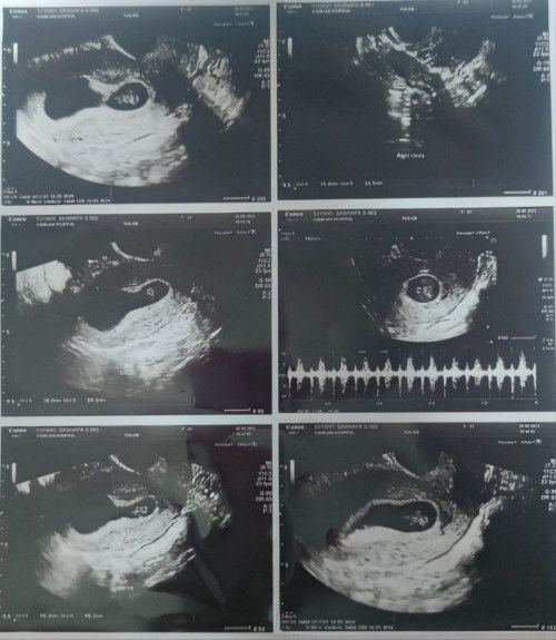 7Week+4Day ภาวะแท้งคุกคาม