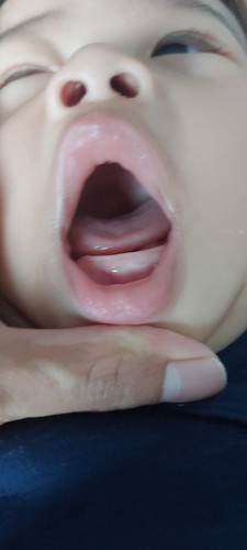 ฟันจะขึ้นใช่มั๊ยคะ