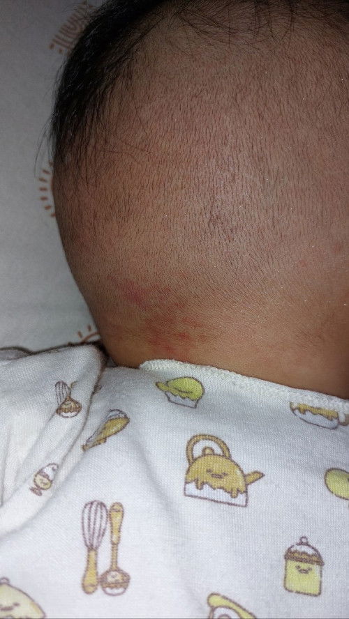 Kemerahan di leher belakang