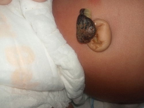 สะดือน้องแบบนี้ปกติไหมค่ะยังไม่หลุด