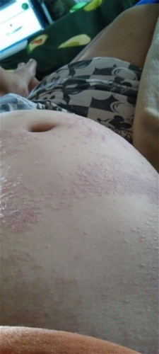 ผื่นคันตอนท้อง