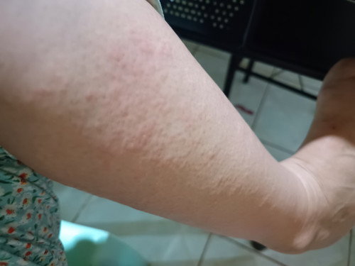 Allergy or tigdas