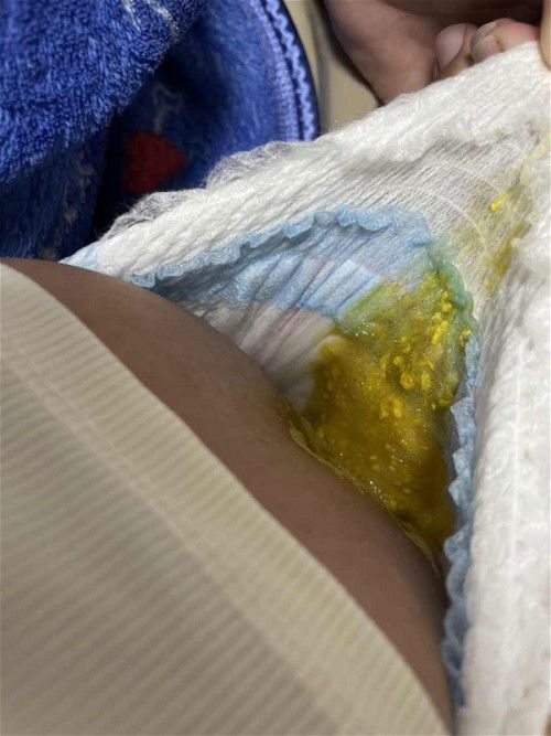 ลูกพึ่งหายจากRSV ตั้งแต่เป็นน้องถ่ายเหลวเป็นเม็ดมะเขือ