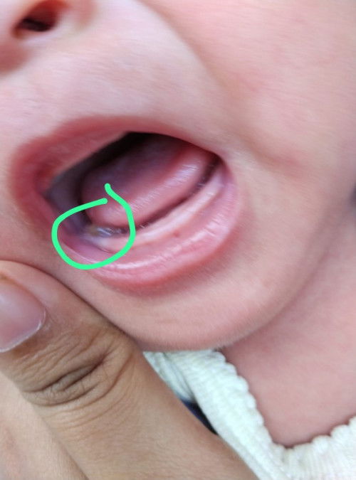 Benjolan putih bening pada gusi bayi 2 bln, bahaya atau tidak ya bun? Sudah 1bln lebih tidak kempes