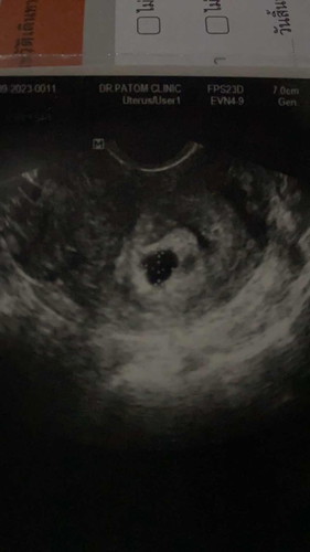 แม่ๆคนไหนเคยเจอเคสถุงตั้งครรภ์ไม่สวยบ้างคะ