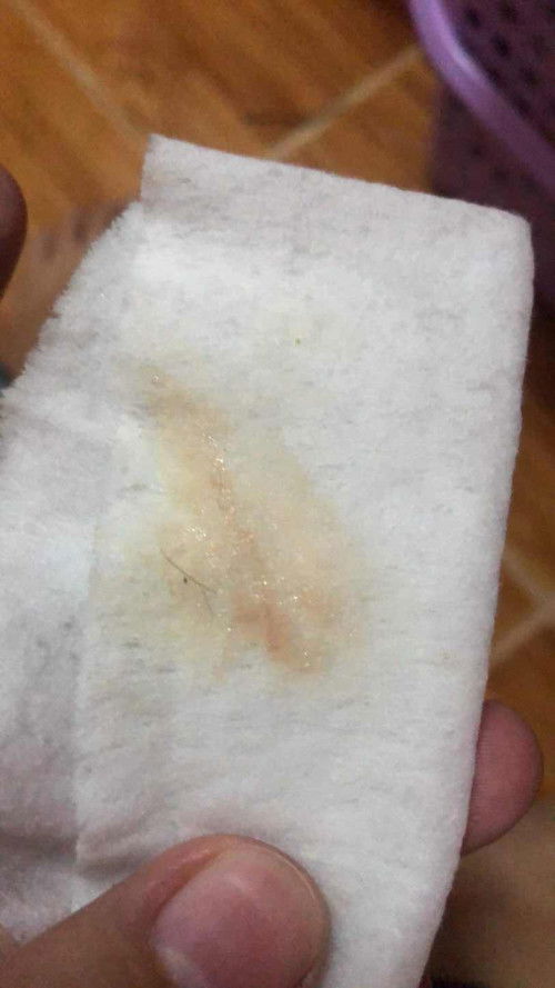 ใช่มูกเลือดไหม