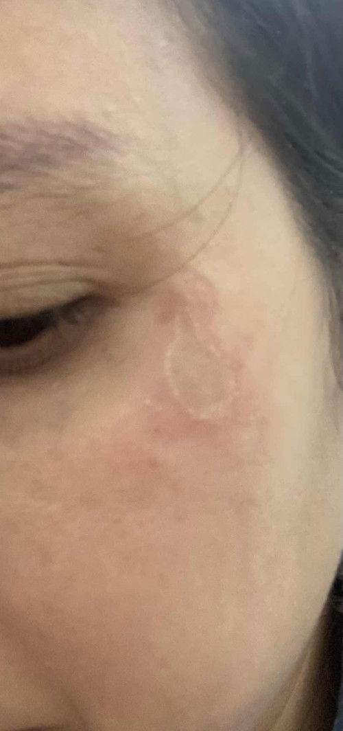 Bị nổi vết chàm trên da