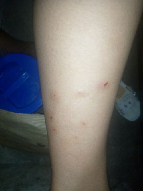 Nakagat Ako Nang Pusa Pwede Poba Ako Magpa Breast feed Kay Baby ?