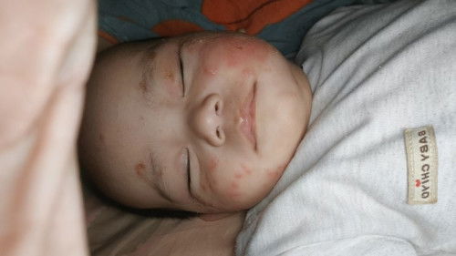 Cara hilanginnya gimana bun, sudah ke dokter kulit 2 minggu pake obatnya ga sembuh juga 🥺