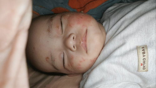 Cara hilangin nya gimana ya  un, udah berobat ke dokter kulit pake obatnya udah 2minggu tetap begitu